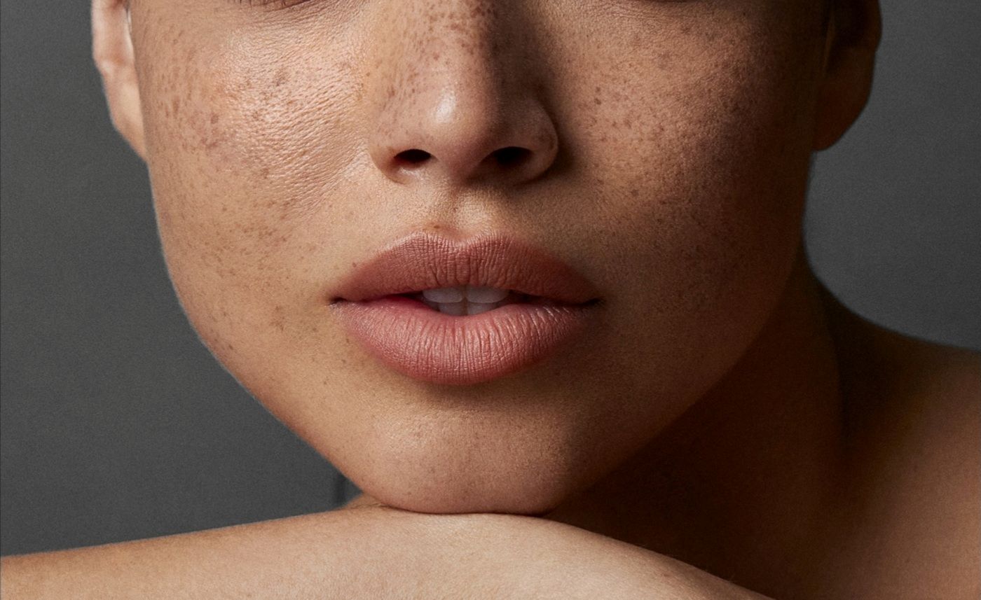 Zbliżenie twarzy kobiety z naturalnie wyglądającymi piegami na nosie i policzkach.