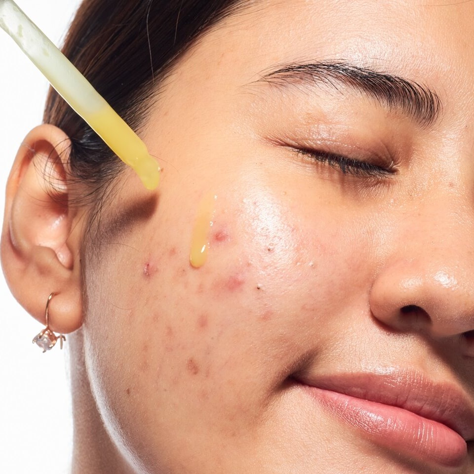 Co pomaga na trądzik? Te składniki są Twoimi sprzymierzeńcami!