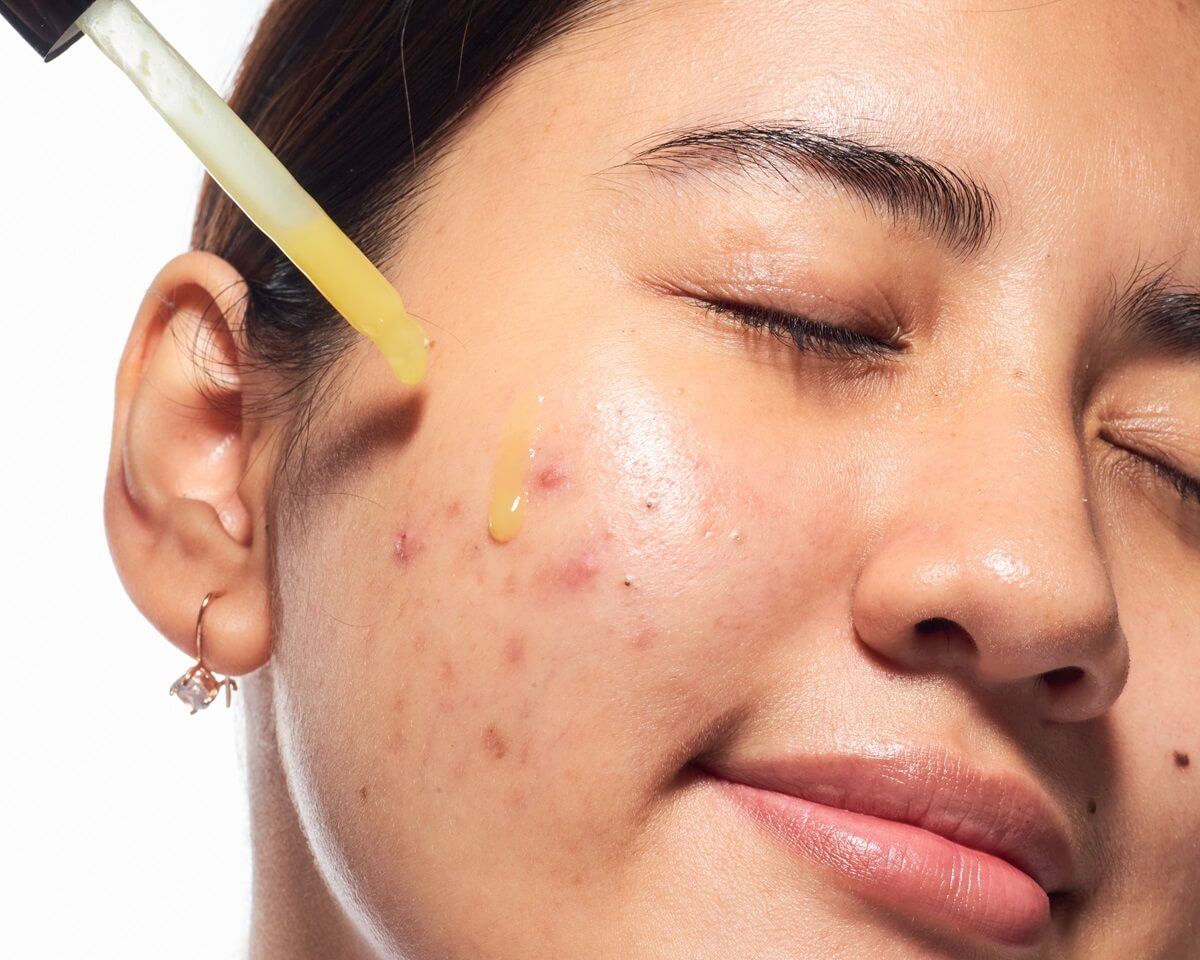 Zbliżenie na twarz kobiety z widocznymi niedoskonałościami, na którą z pipety nakładane jest serum.